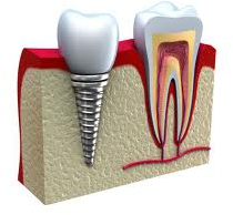 Dental implant bucharest
