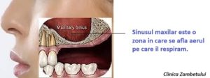 Aditie de os la nivelul sinusului maxilar